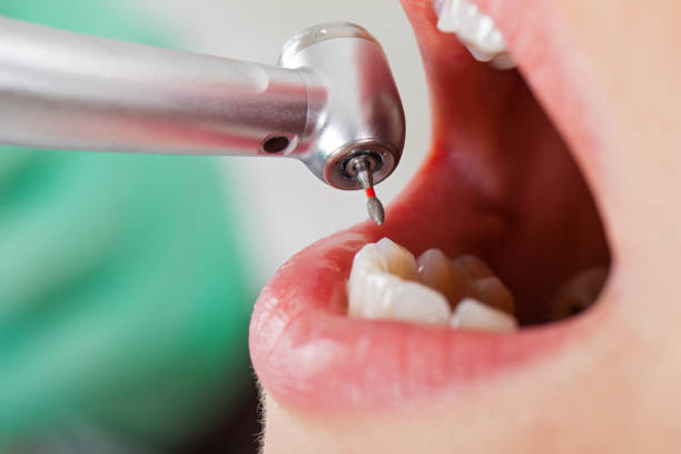 Best Emergency Root Canal Therapy in Kittredge, CO